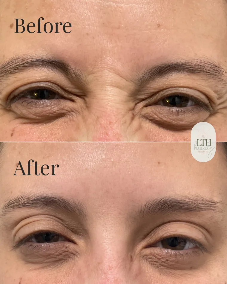 Before and after — neurotoxin treatment for frown lines, the 11s