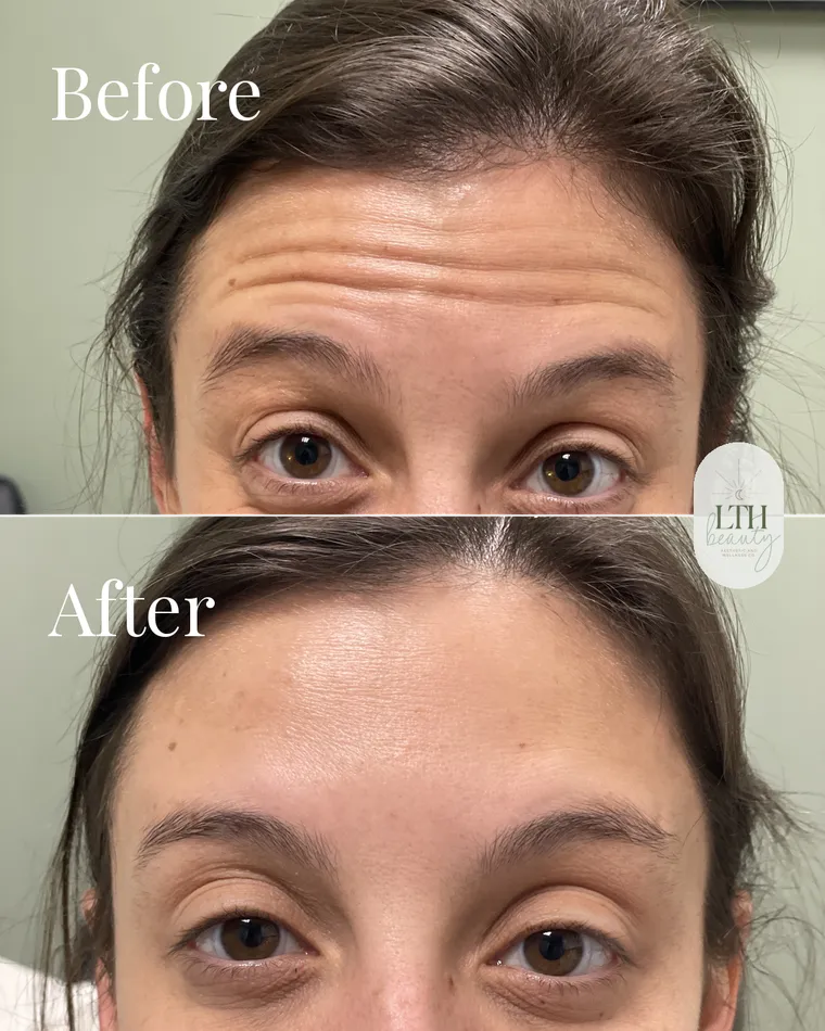 Before and after — neurotoxin treatment for forehead lines (upper-face view)