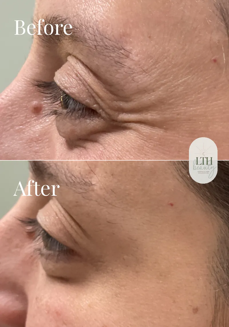 Before and after — neurotoxin treatment for crow's feet (side view)