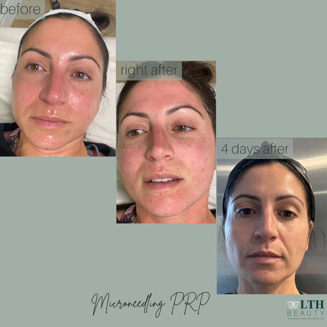 Microneedling with PRP — before, right after, and 4 days after treatment