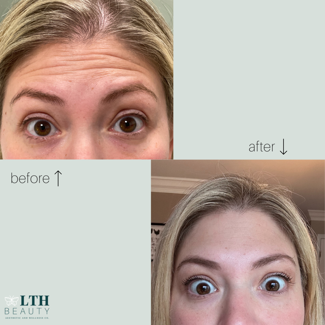 Before and after: forehead lines