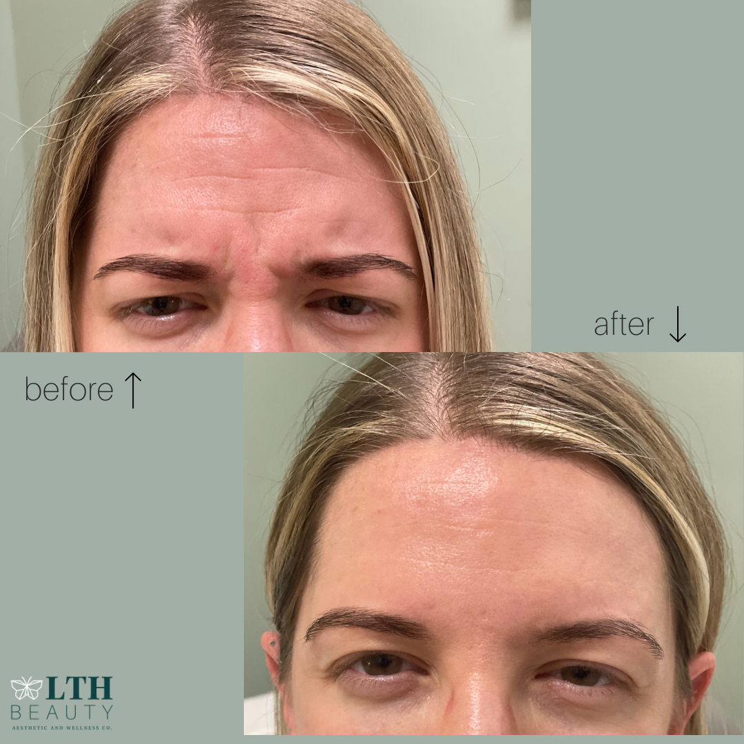 Before and after neurotoxin treatment — forehead lines softened