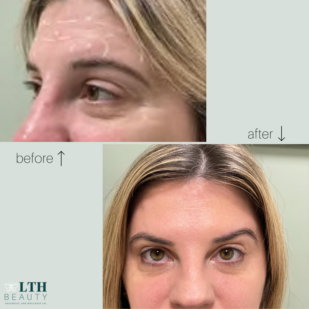 Before and after: crow's feet