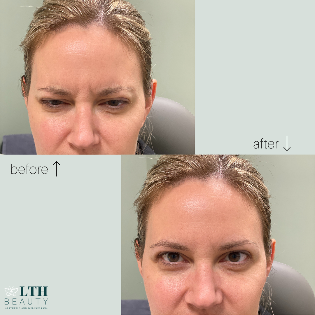 Before and after: frown lines