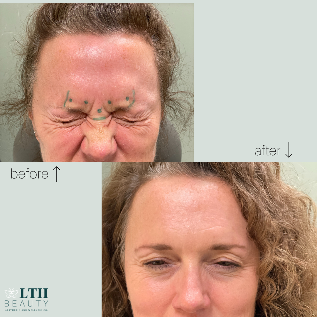 Before and after: bunny lines