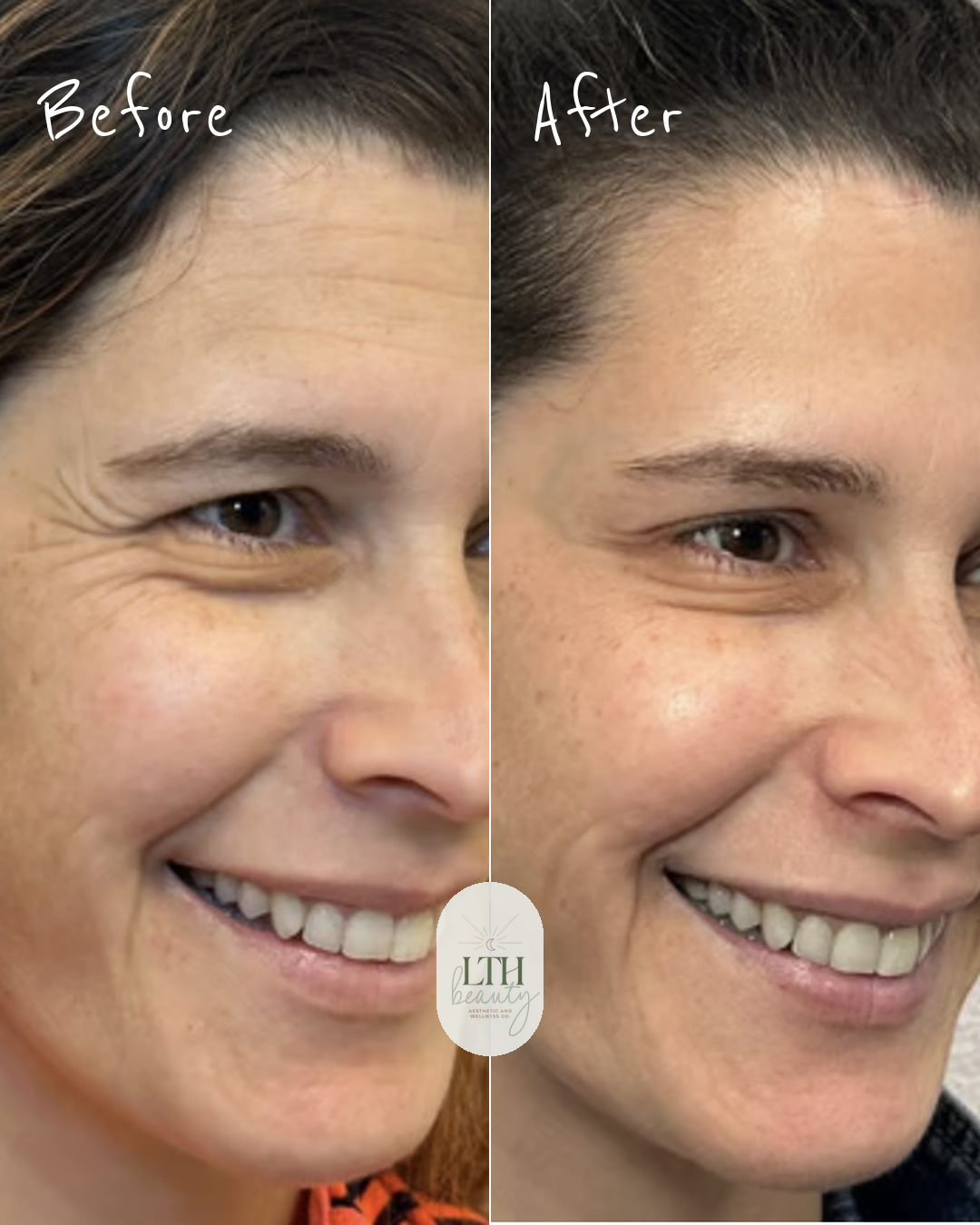 Before and after: forehead lines